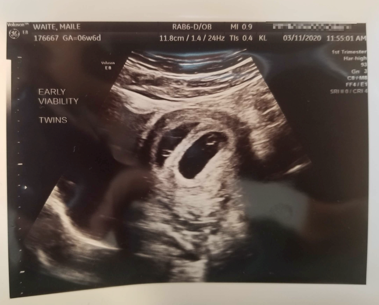 Maile Waite ultrasound picture of twins