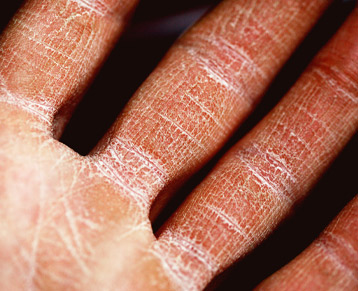 Dry skin