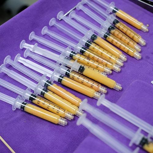 ADR-C Facial Enhancement (Facial Fat Grafting/Fat Transfer/Fat ...