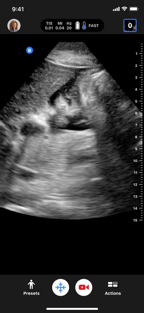Point of care ultrasound at the bedside in E Med Butterfly iQ3