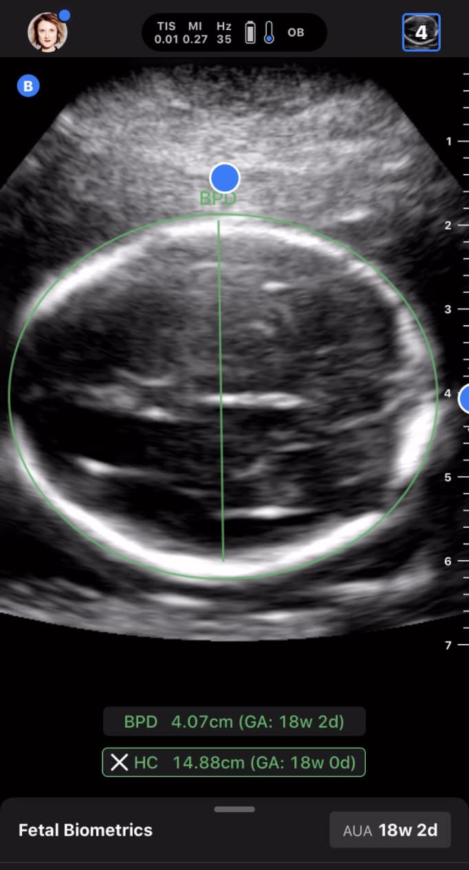 OB/GYN POCUS images | Butterfly iQ