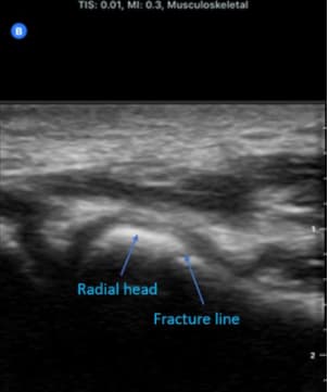 Case Studies Point Of Care Ultrasound A Sideline Game Changer