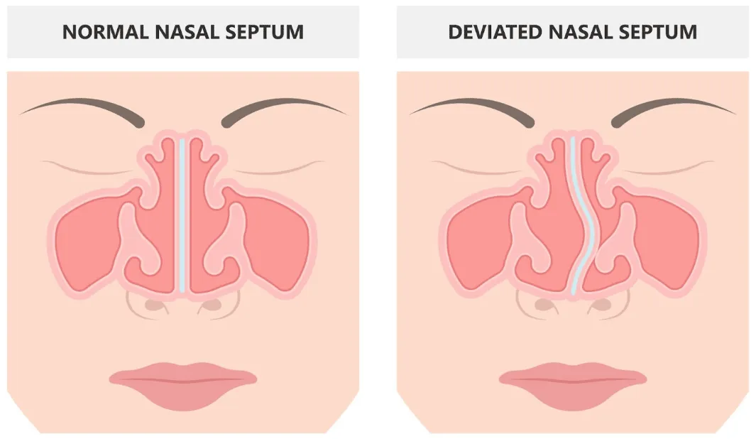 Septoplasty: Your Fix for Deviated Septum | Capitol Breathe Free