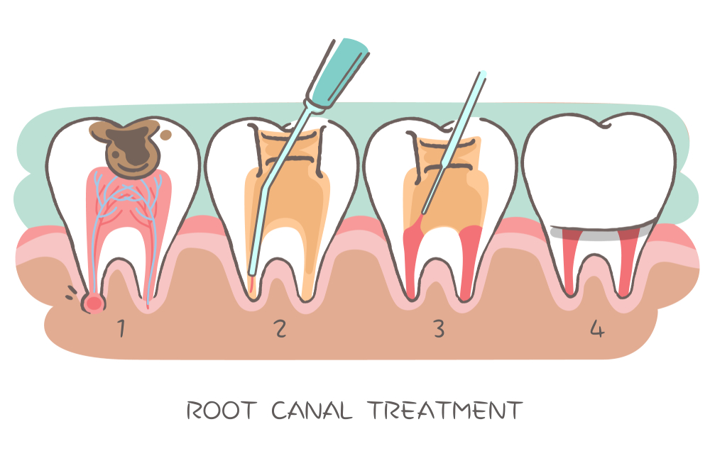 Root Canal vs. Extraction What’s the Right Choice? Same Day Dental Blog