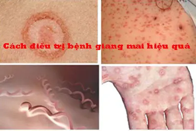 Phương pháp điều trị bệnh giang mai hiệu quả