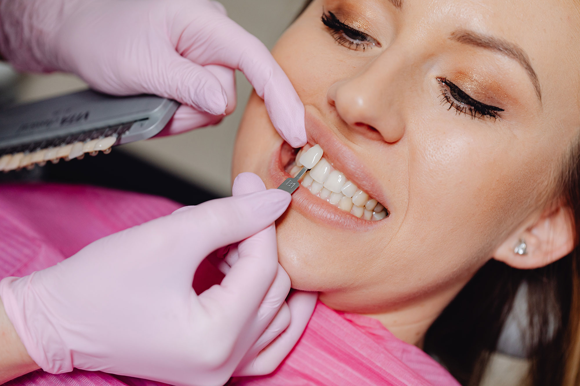 How Long Do Veneers Last? Porcelain vs. Composite