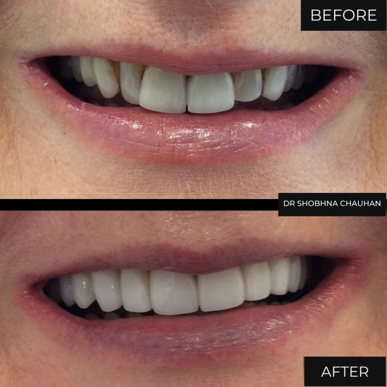 Porcelain Veneers Treatment Birmingham