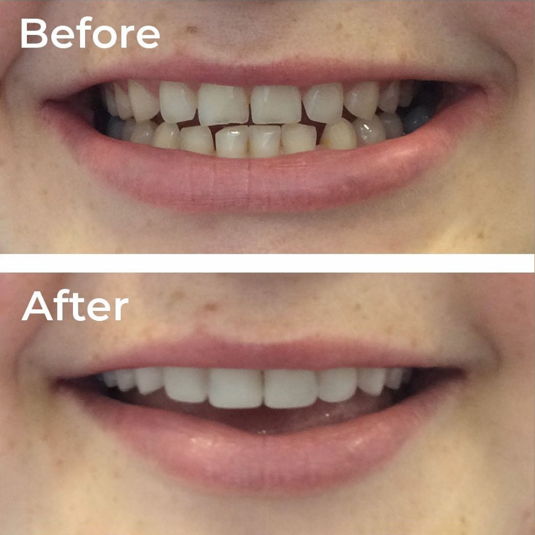 Composite Bonding Birmingham Same Day Smile