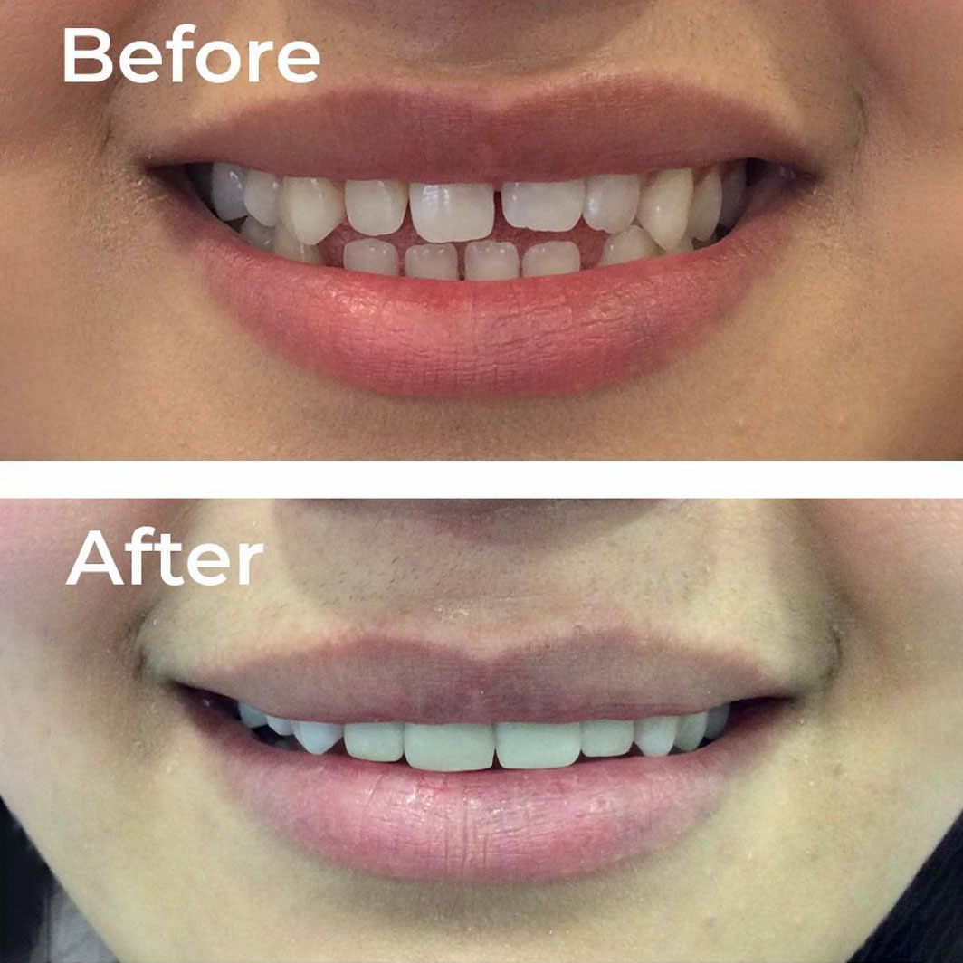 Composite Bonding Birmingham Same Day Smile
