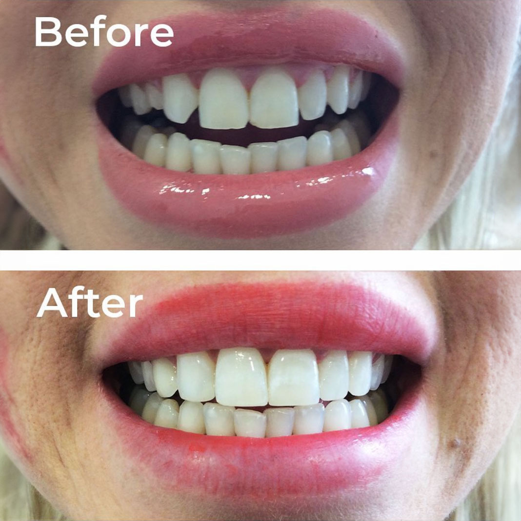 Composite Bonding Birmingham Same Day Smile