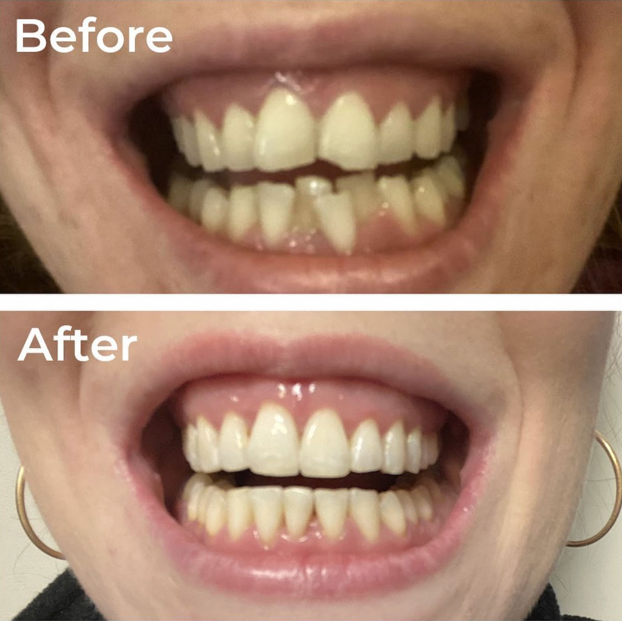 Composite Bonding Birmingham Same Day Smile