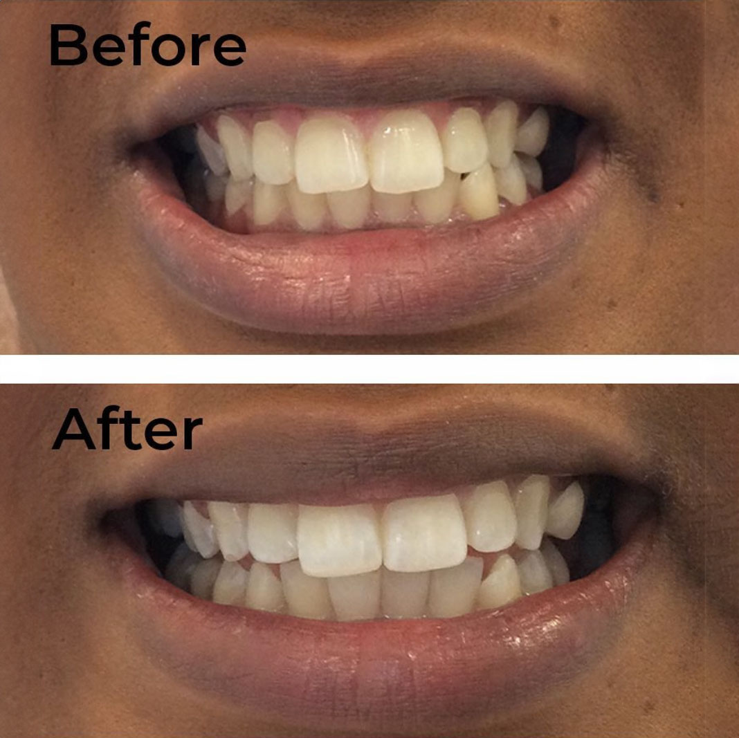 Composite Bonding Birmingham Same Day Smile