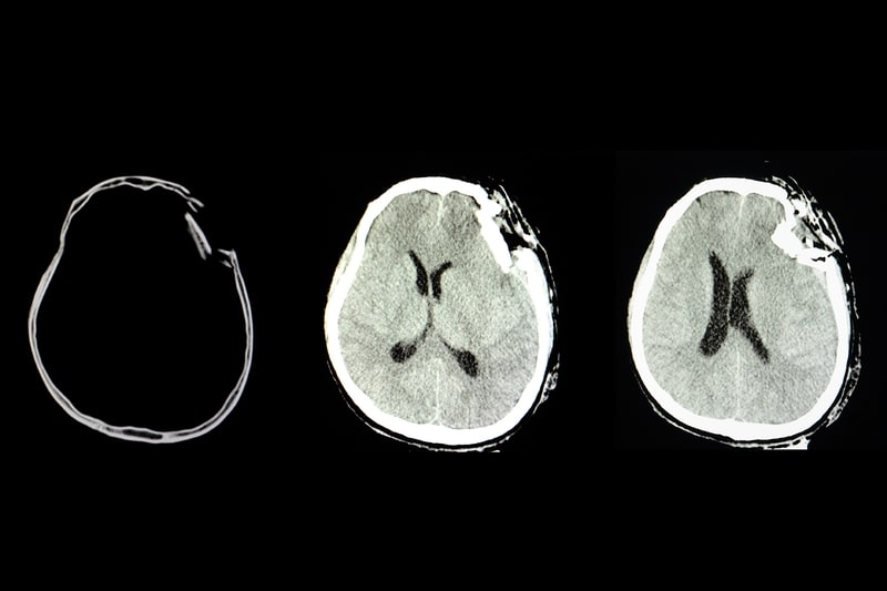 Trauma cranico: cause, sintomi e cure | Mario Negri