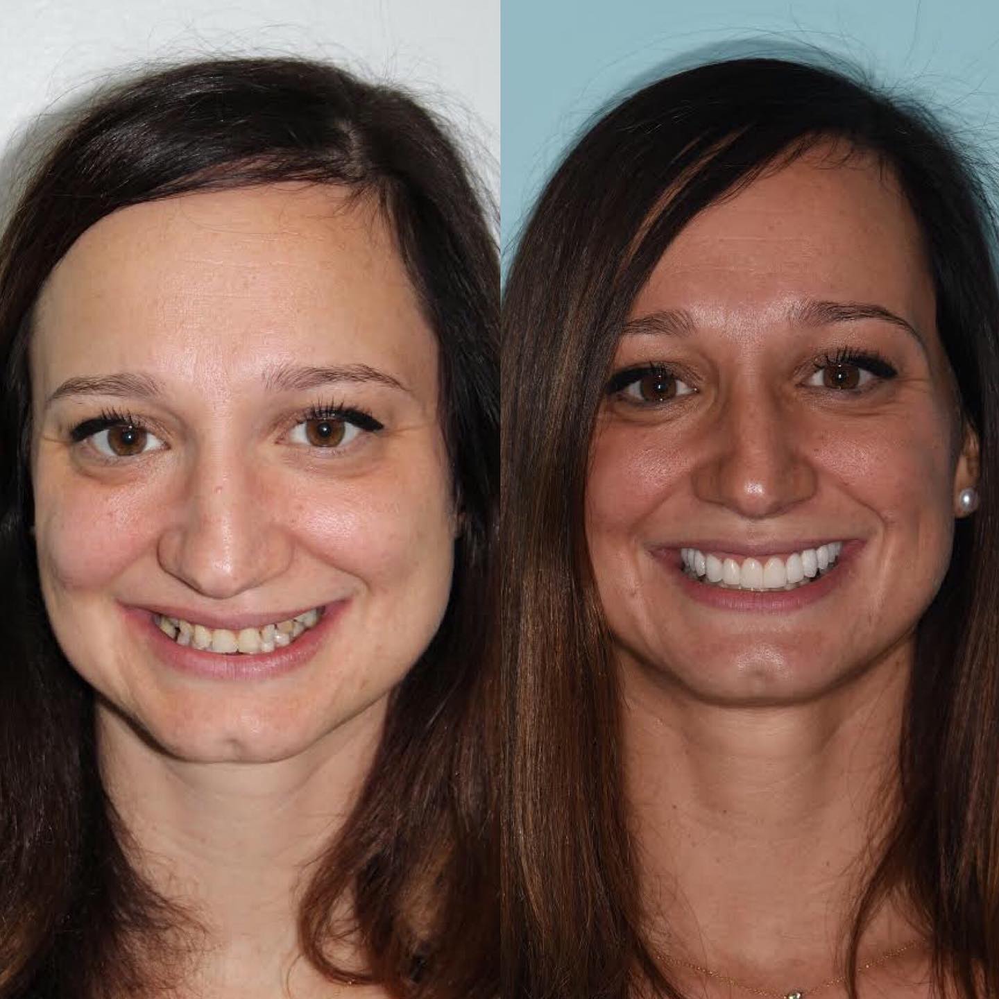 East Pennsylvania Invisalign Smile Culture Dental