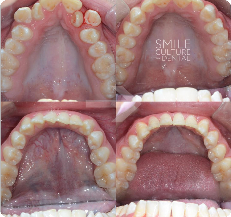 East Pennsylvania Invisalign Smile Culture Dental