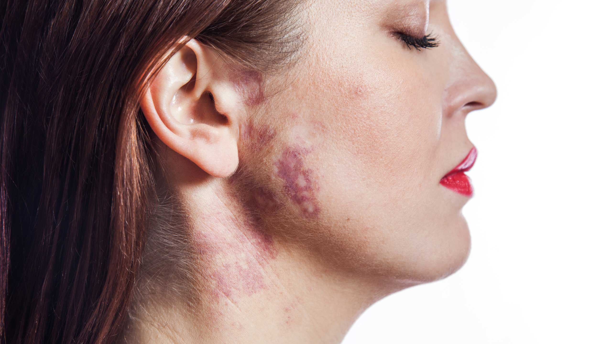 What Causes Hemosiderin Stain And What Treatments Are There 