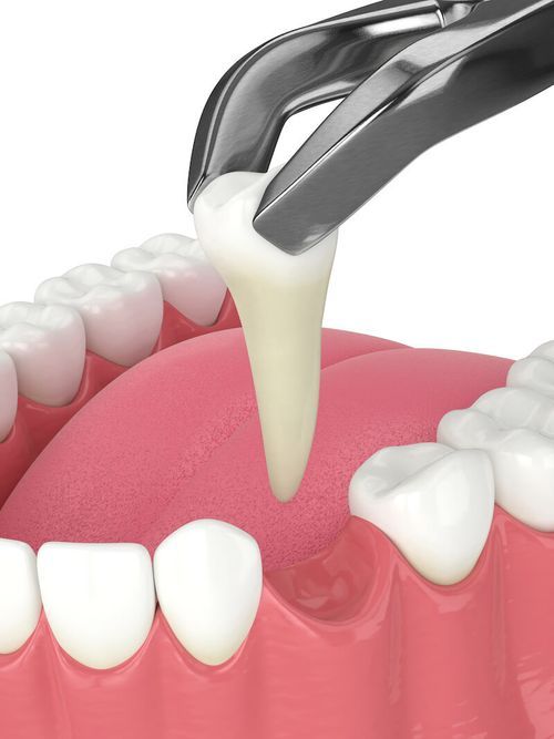 Tooth Extraction Healing Timeline | North Billerica Smiles