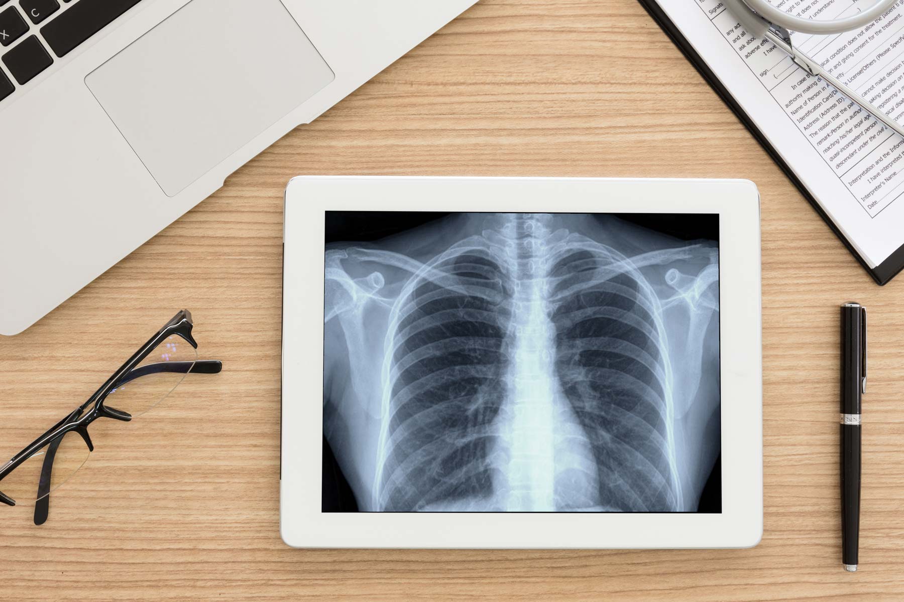 Is High Vitamin B12 Status a Cause of Lung Cancer?