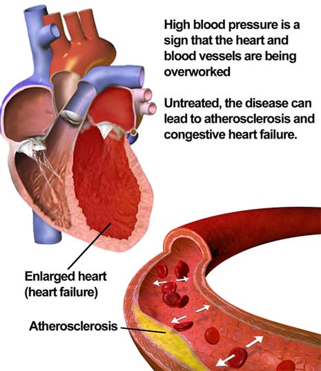 What is high blood pressure aka hypertension