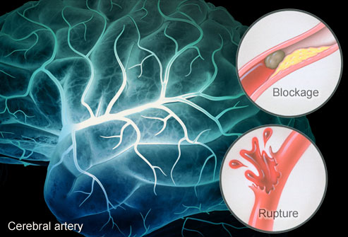 How a stroke occurs