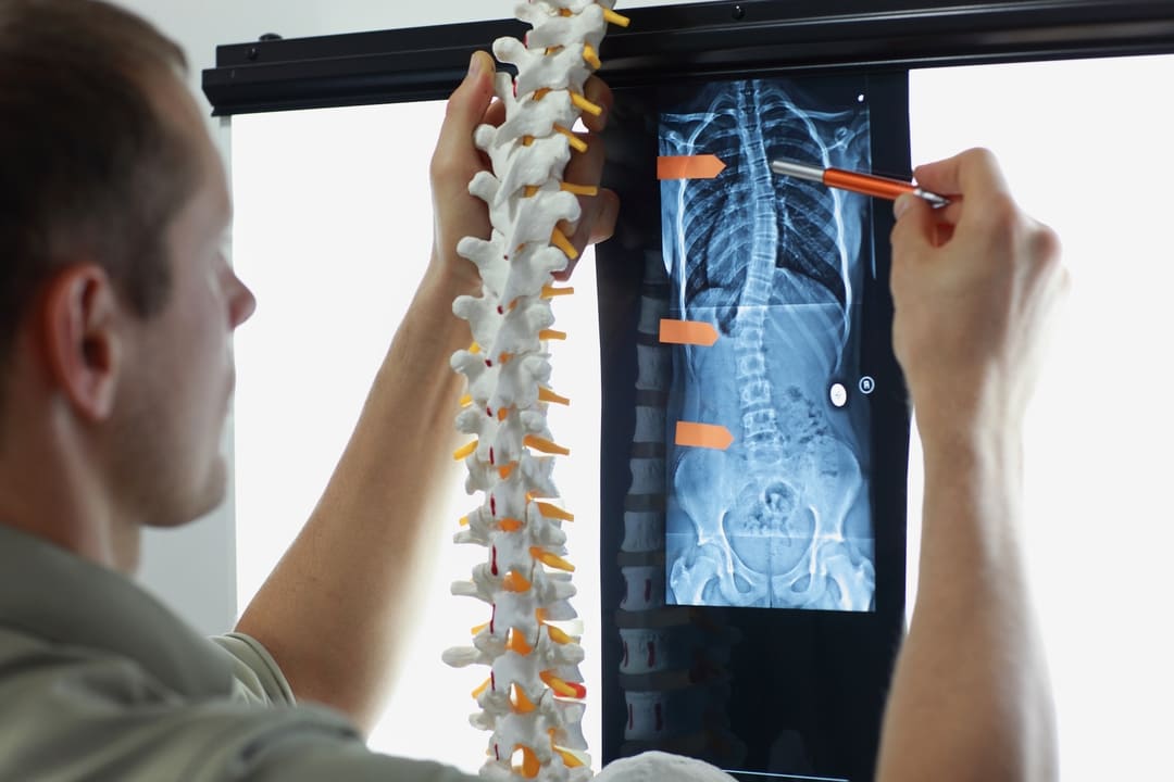 Complete Guide to Scoliosis: Types, Causes, and Treatment | Dorsal