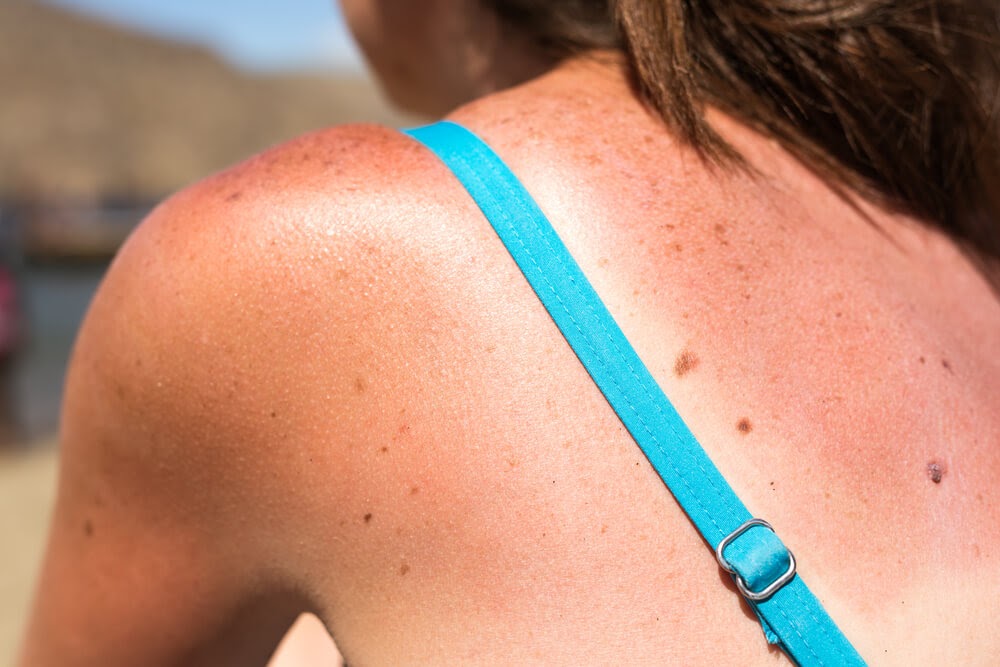 Close up of a woman's sunburned shoulder