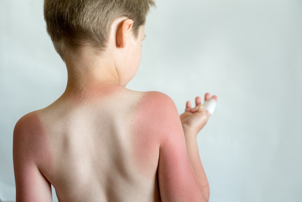 Boy with sunburned back