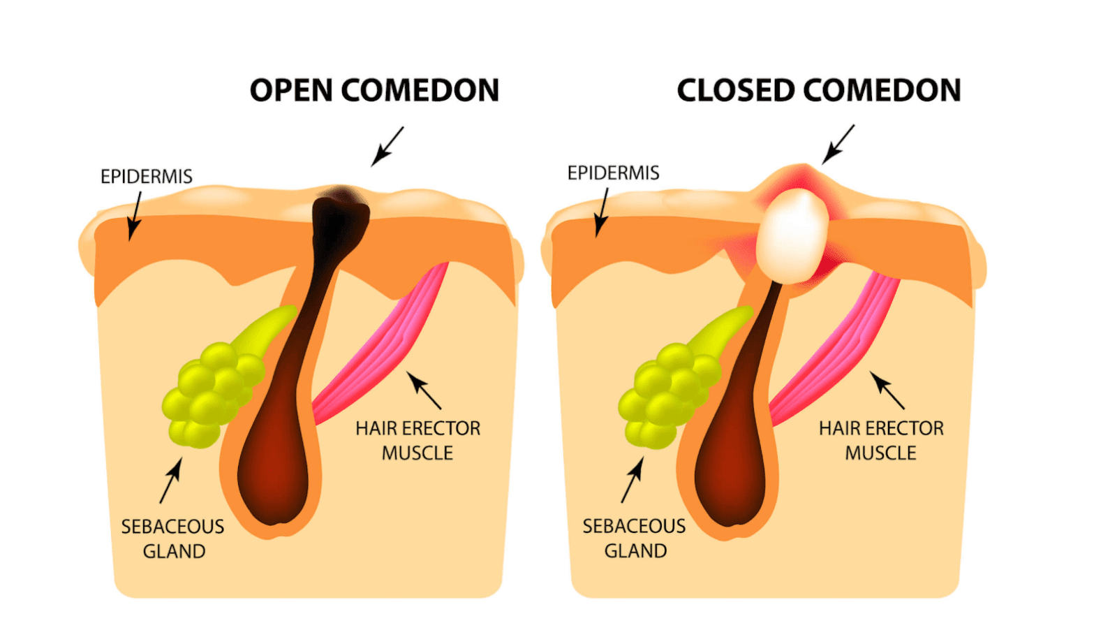 Image showing what an open and closed comedone is