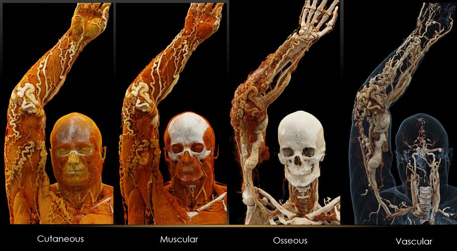 Volume Rendering example showing different levels of image visualization on a human body.