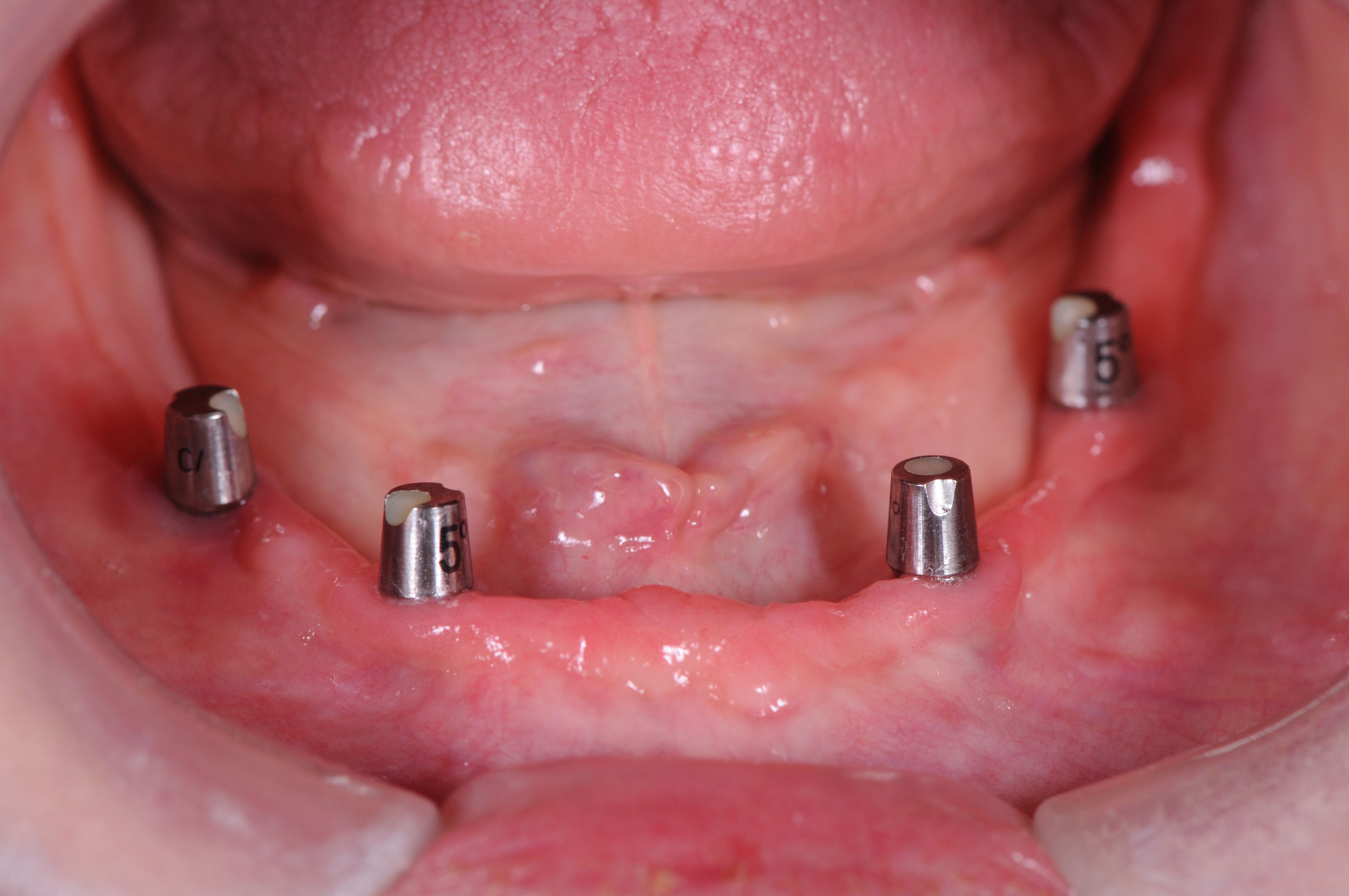After implant placement