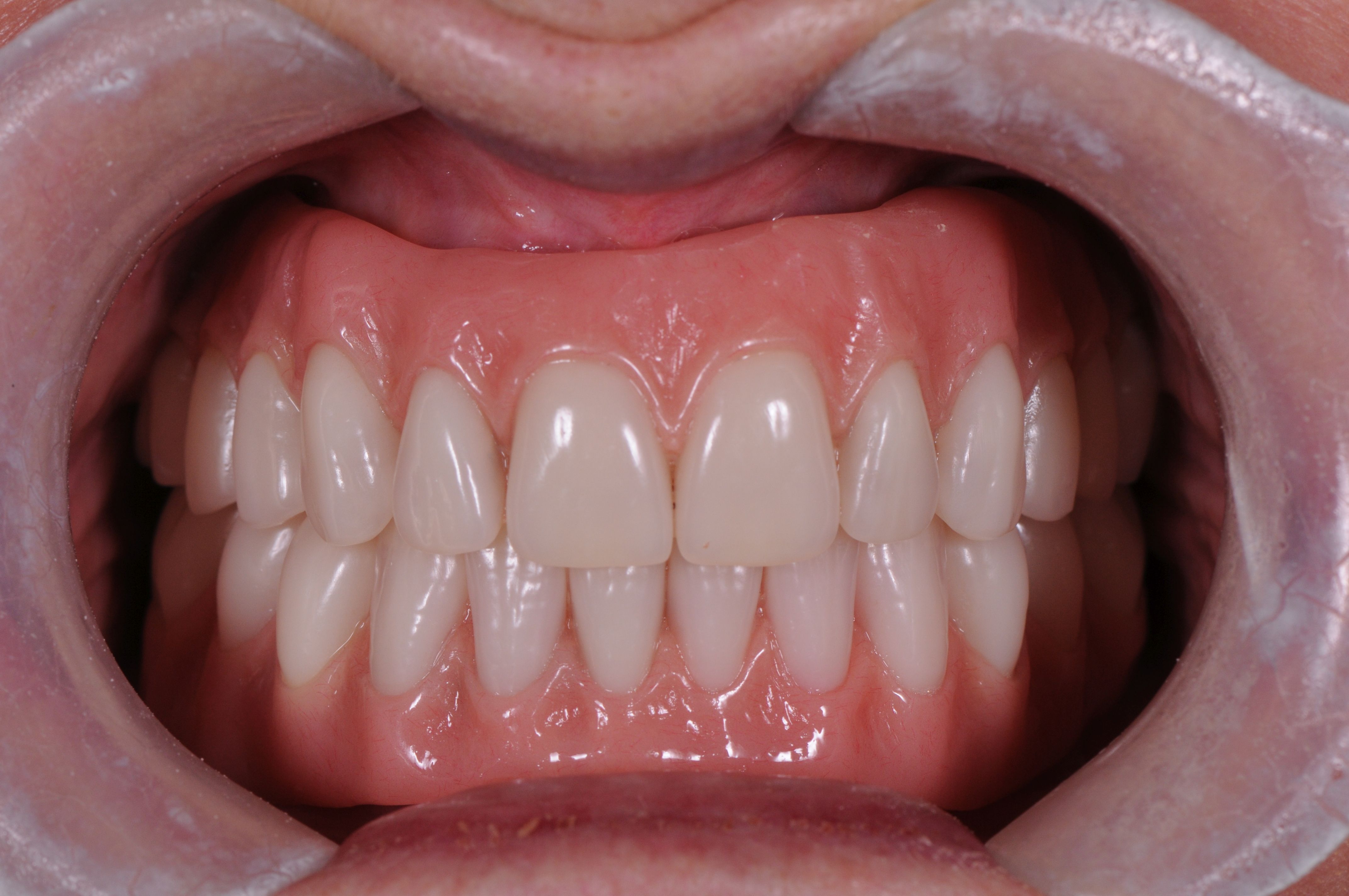 The bridges fitted into place