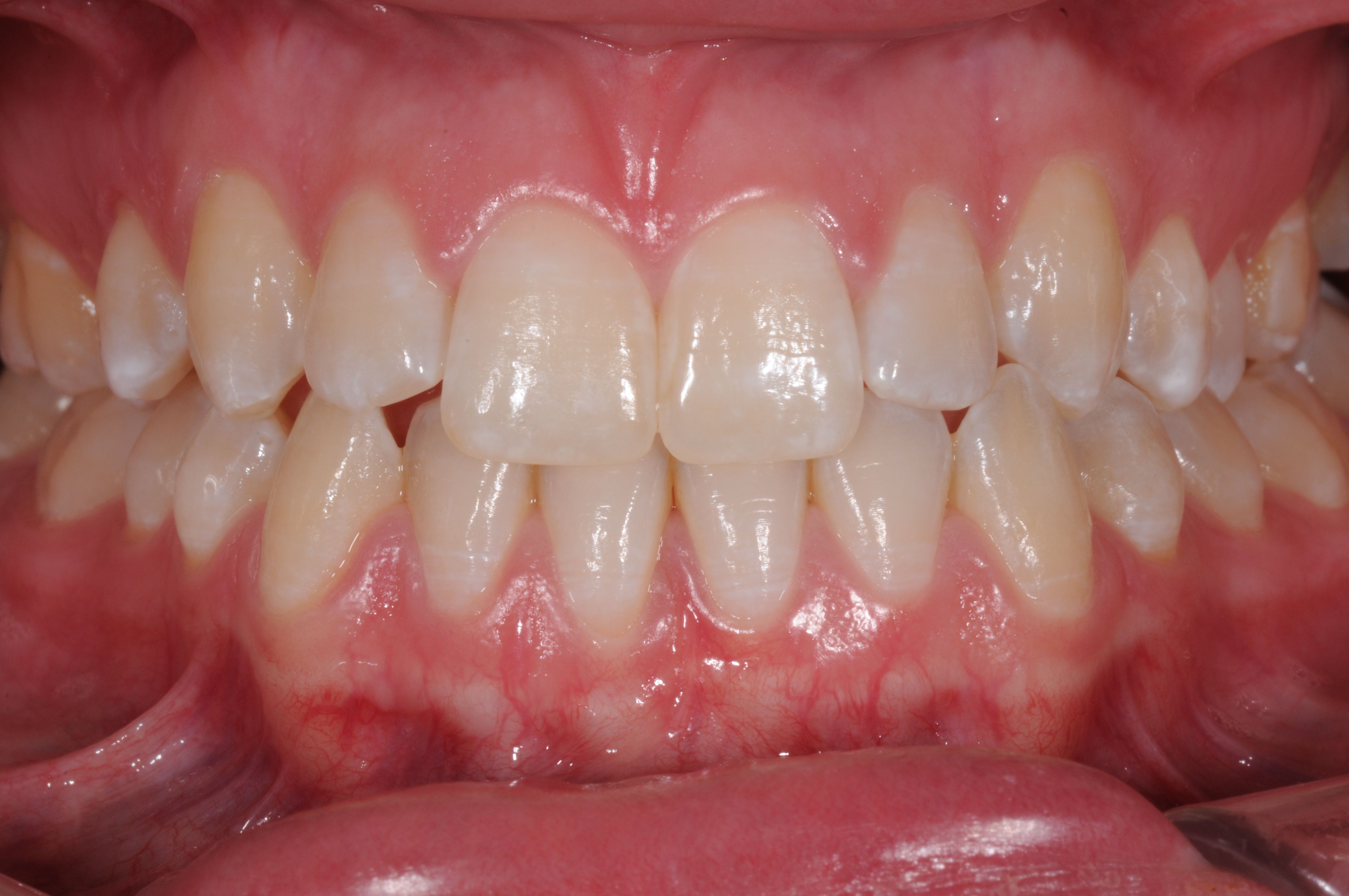 Services Whitening all Teeth Brisbane Prosthodontics