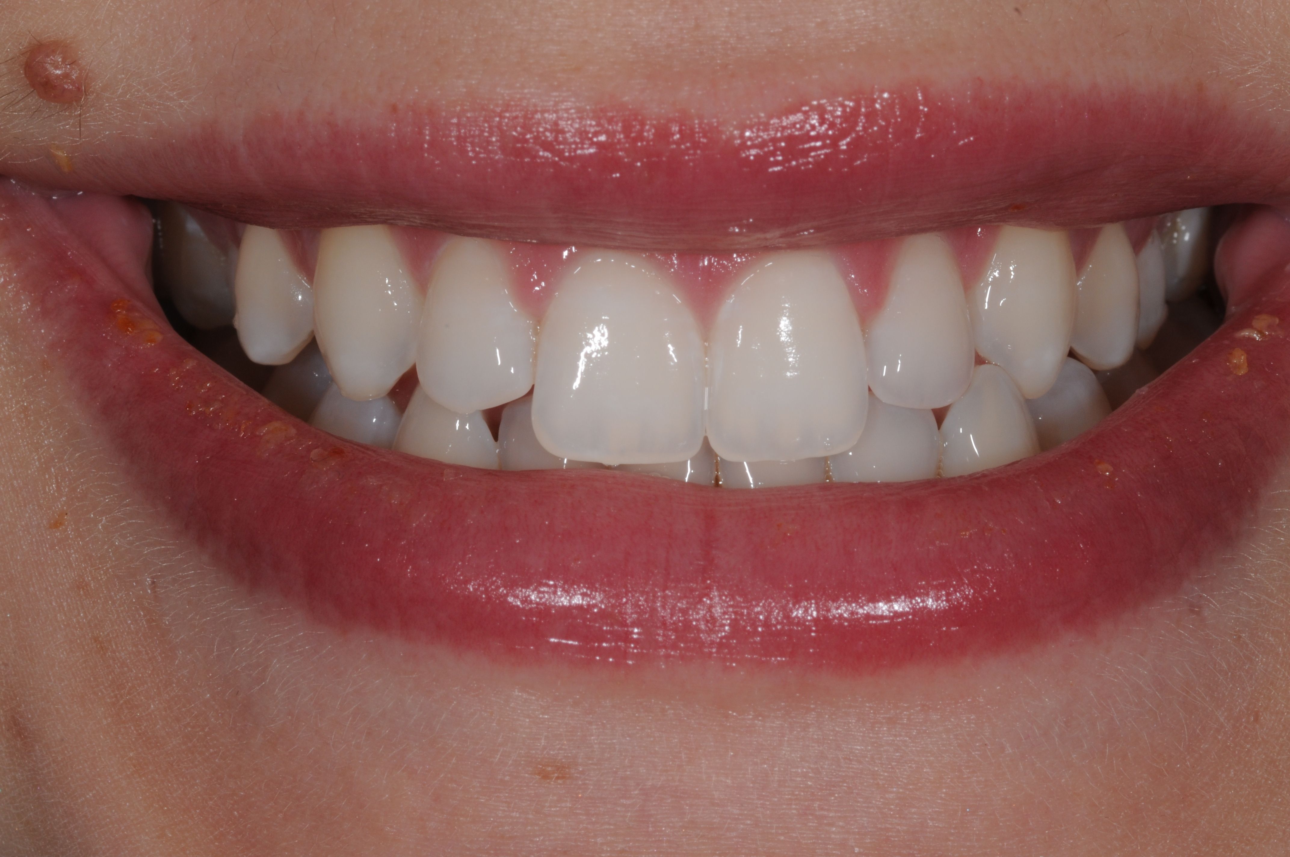 Services Whitening all Teeth Brisbane Prosthodontics