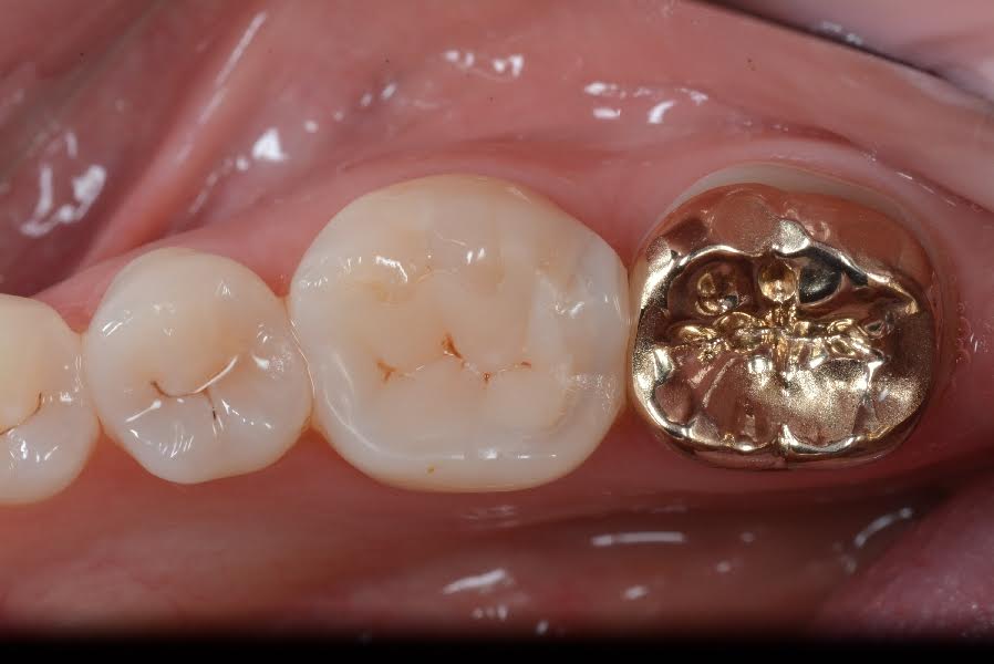 Services Gold Crowns Brisbane Prosthodontics