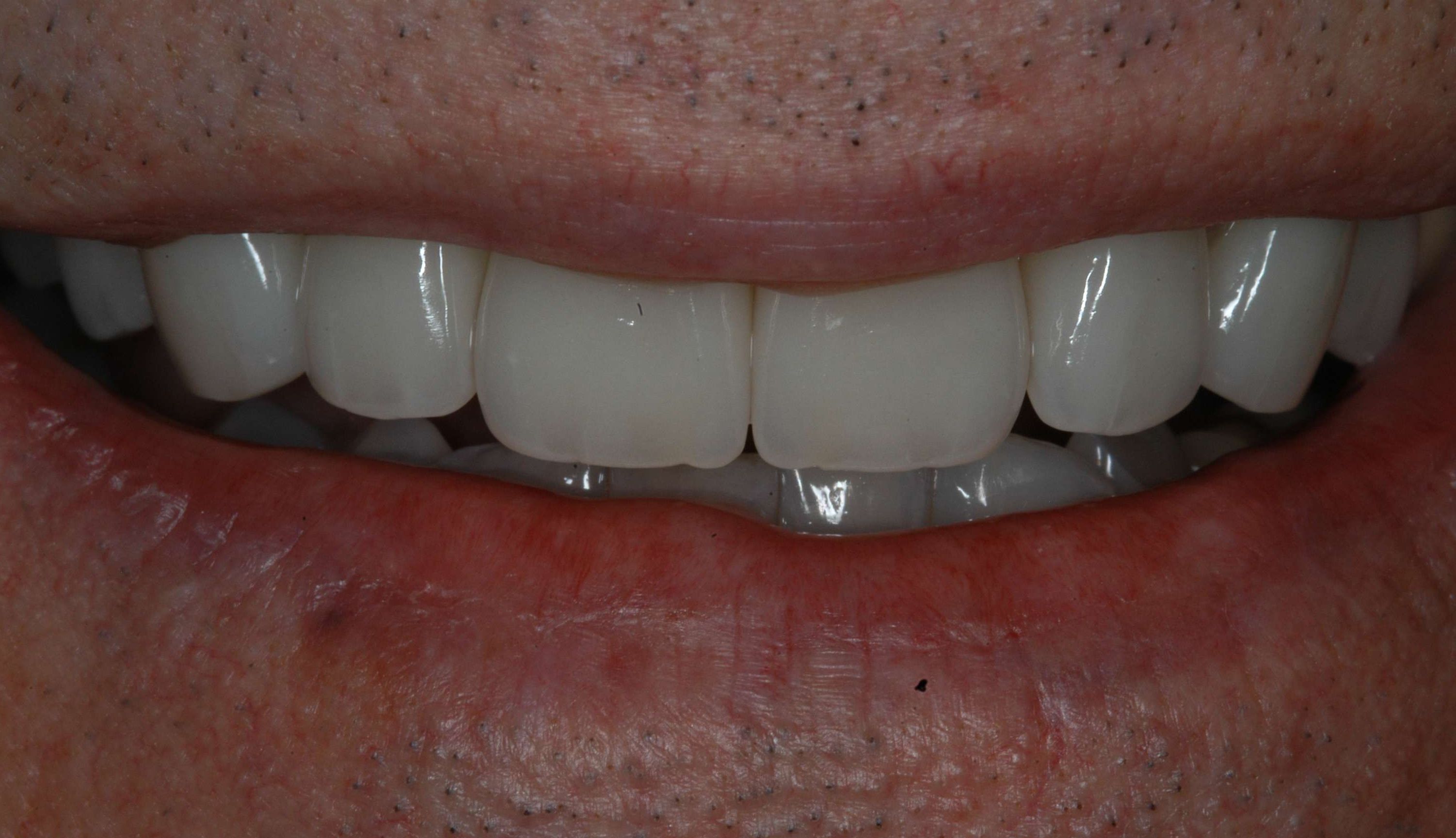 A new, younger smile