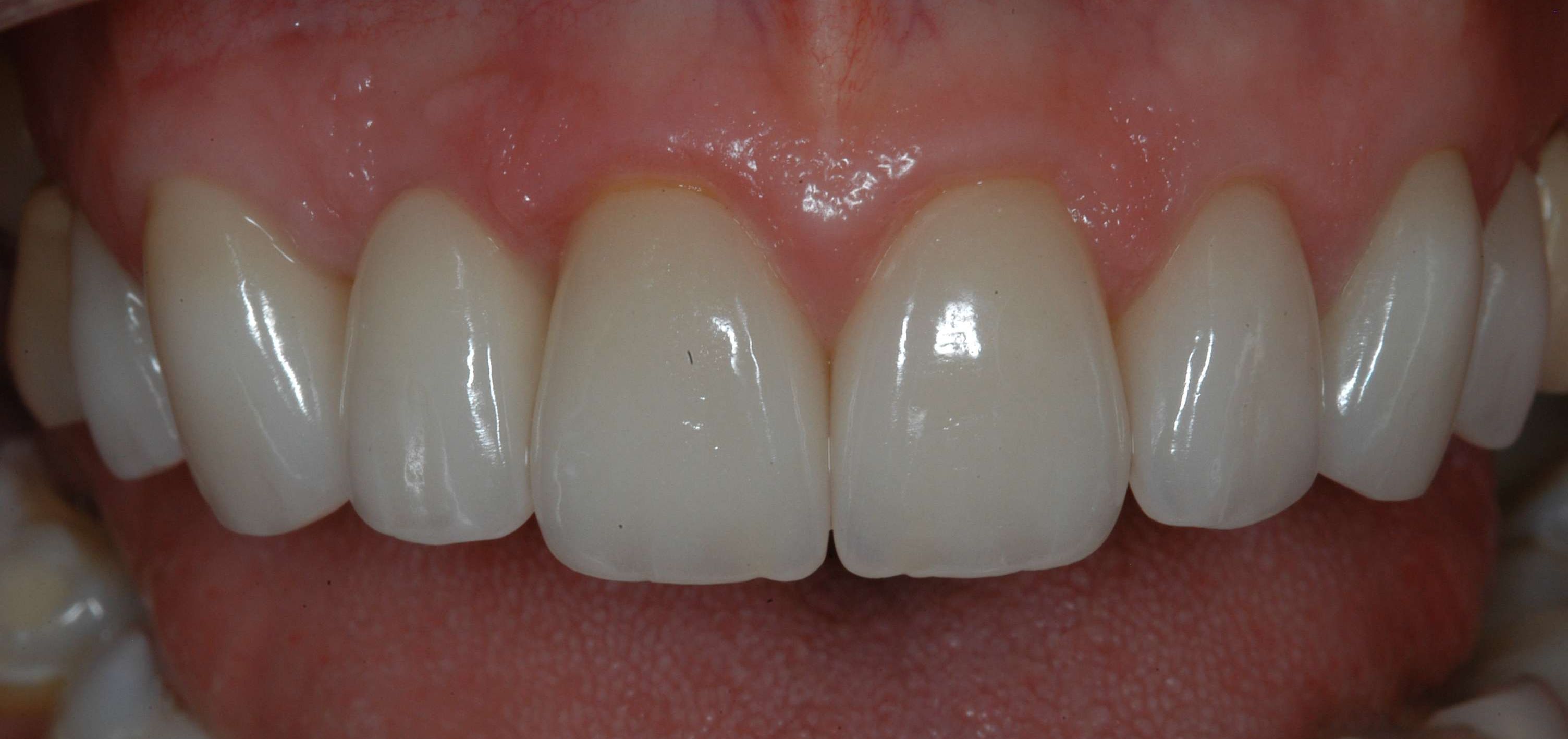 New all-porcelain crowns