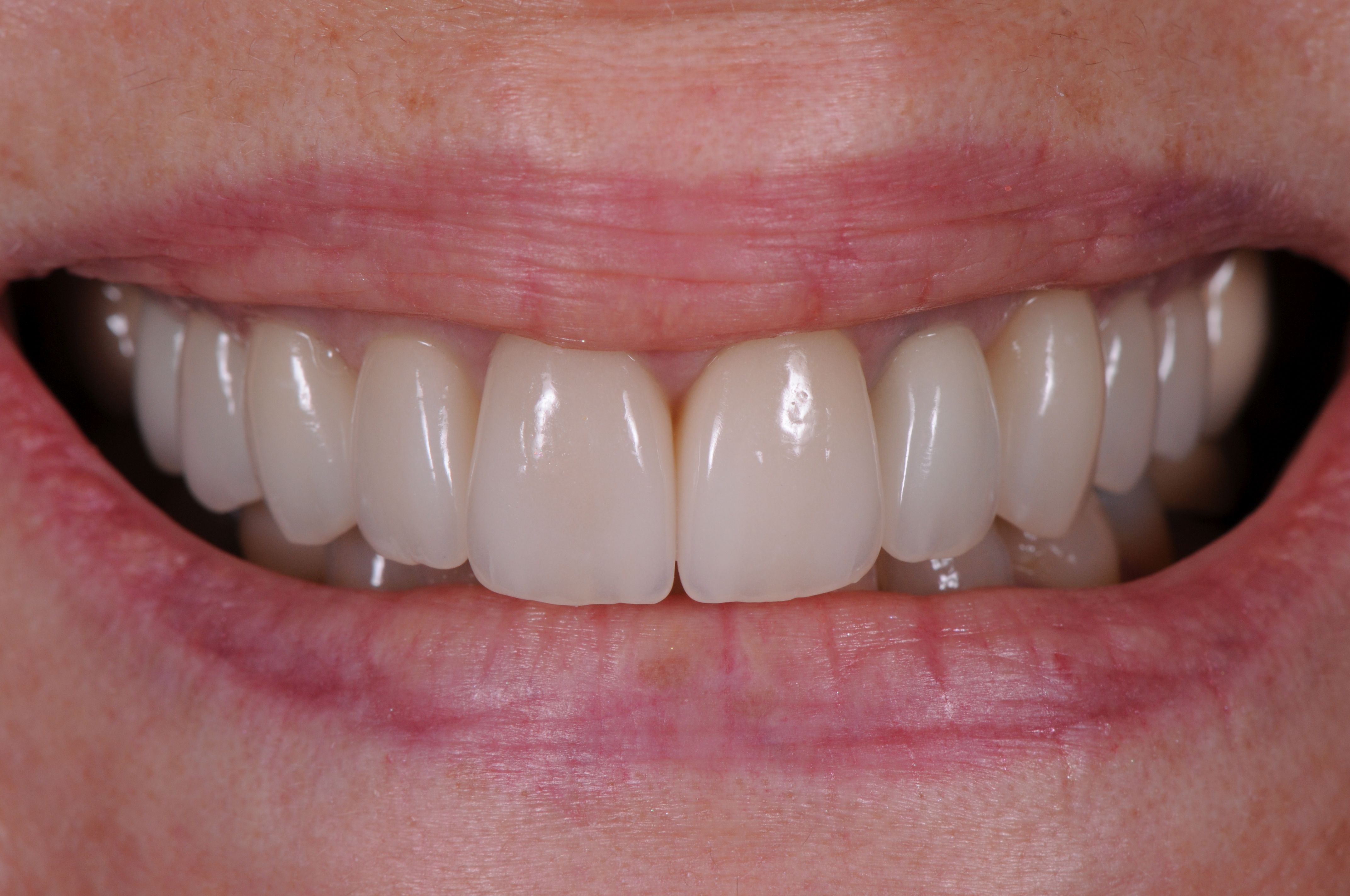 The perfect, natural-looking outcome