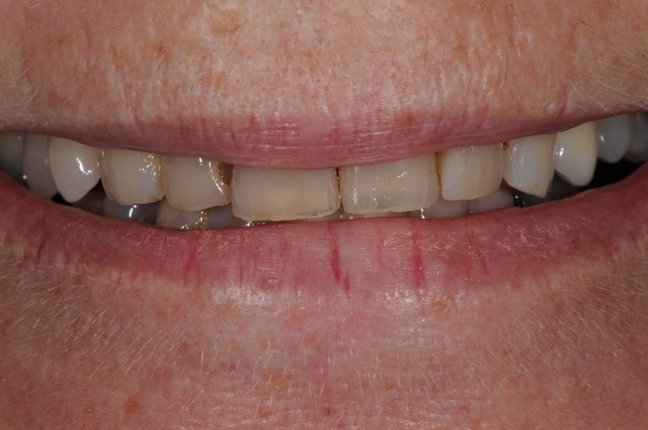 The old and worn teeth