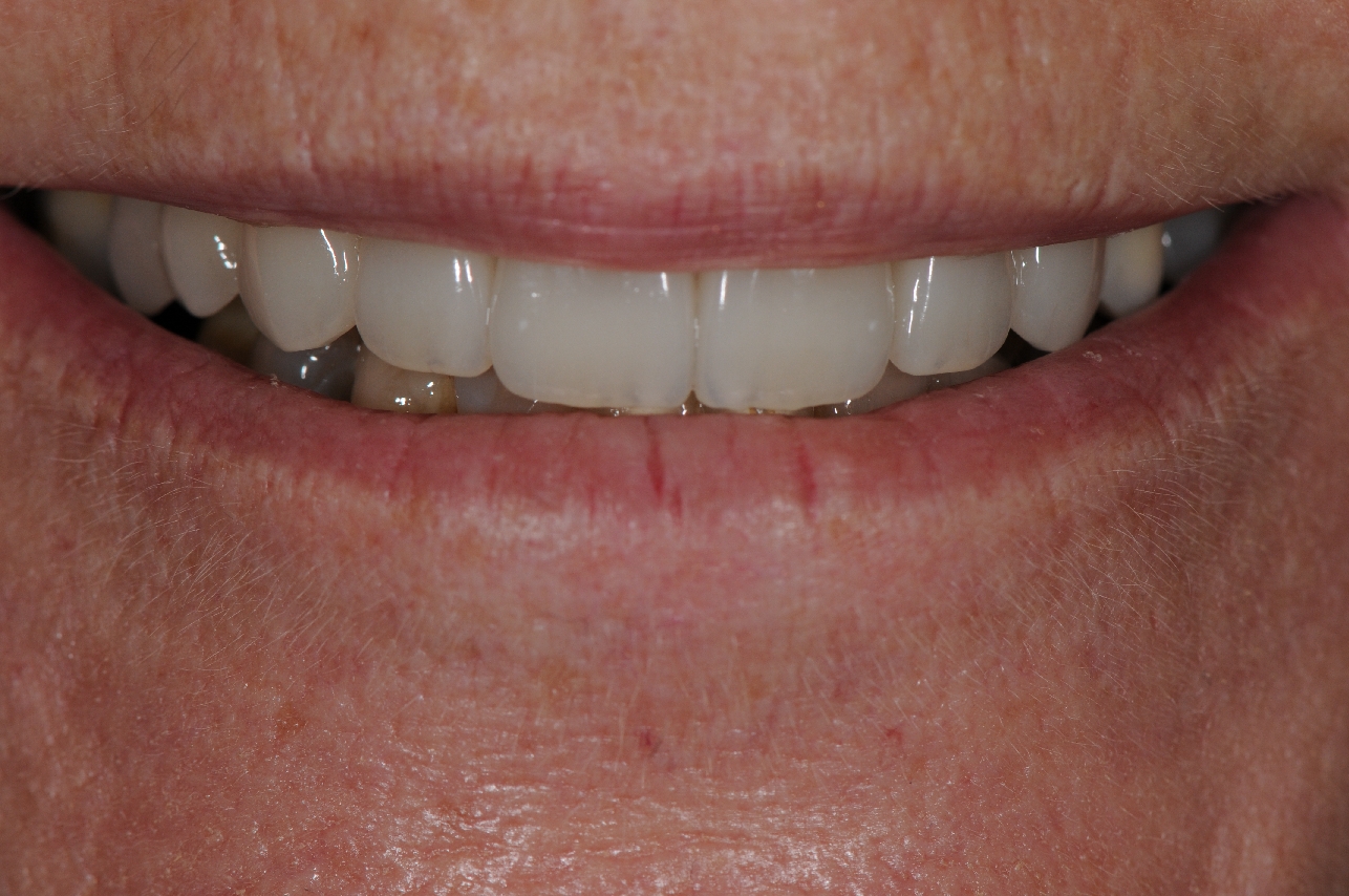 More beautiful smile