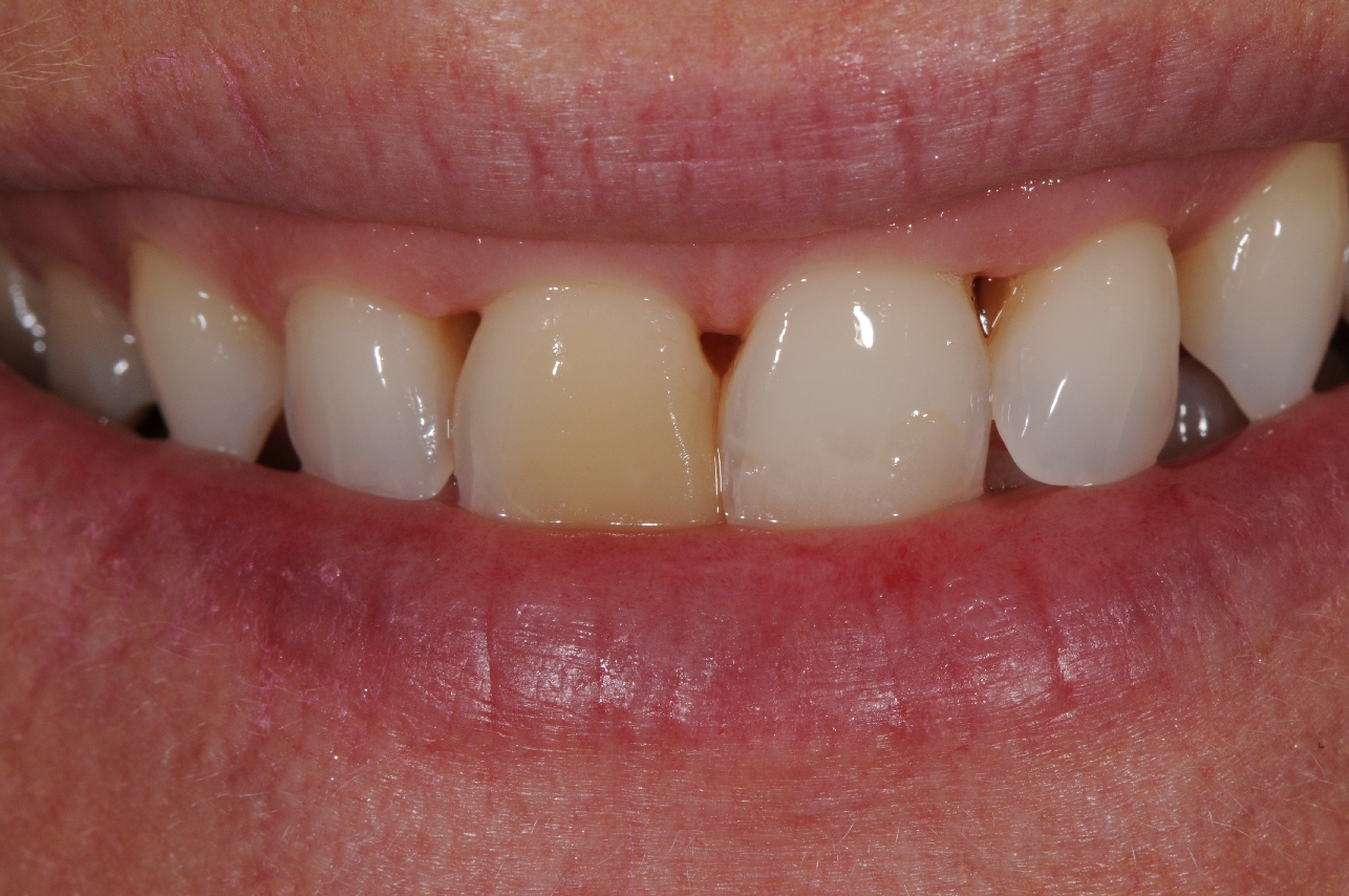 Old fillings and black spaces