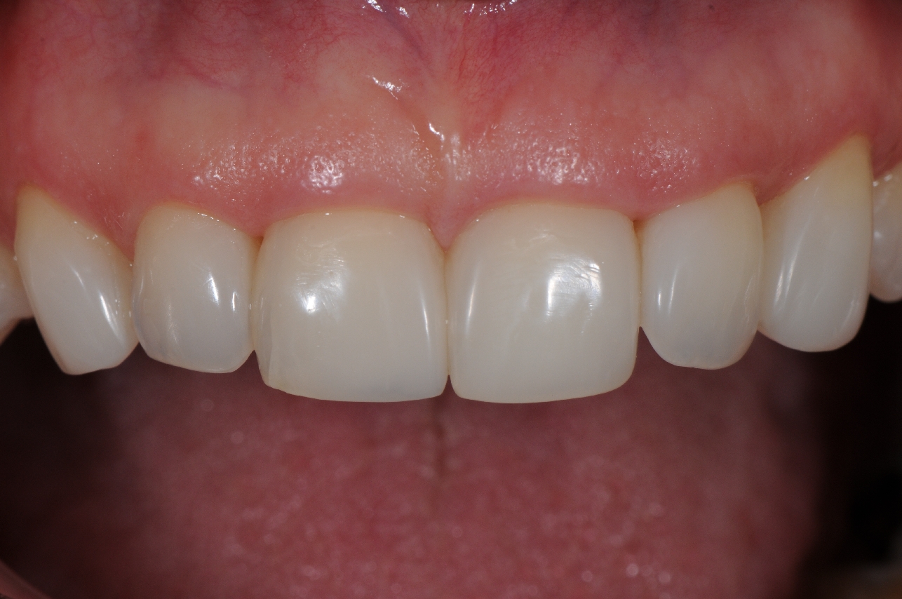 Closing the spaces !