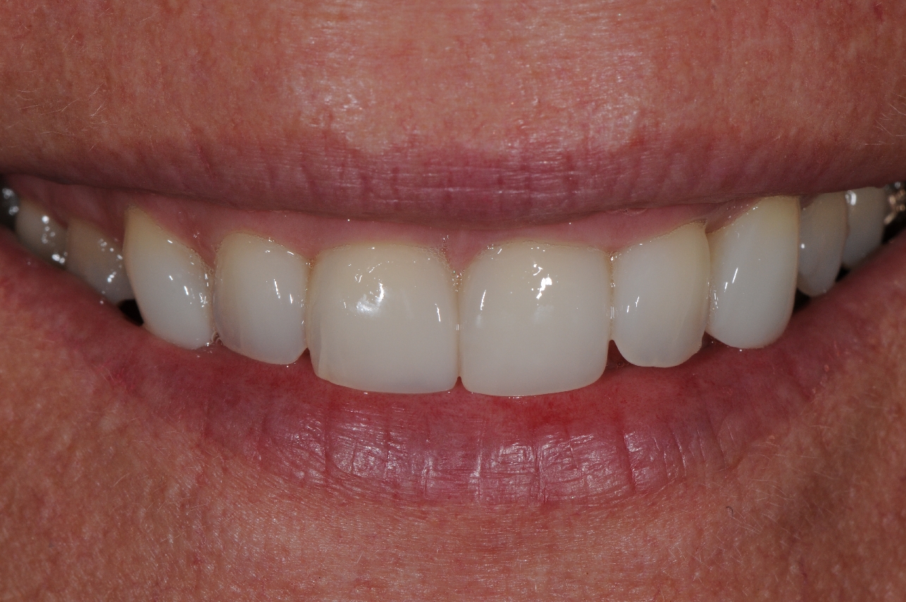 The new younger smile