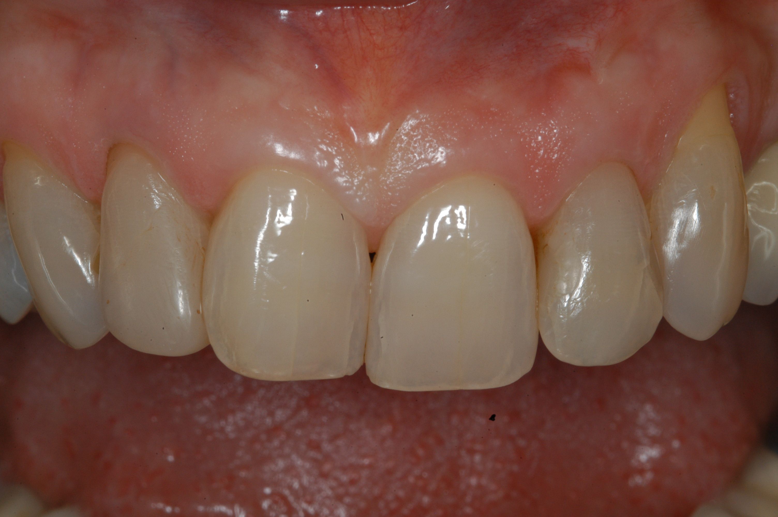 Old fillings and stained teeth