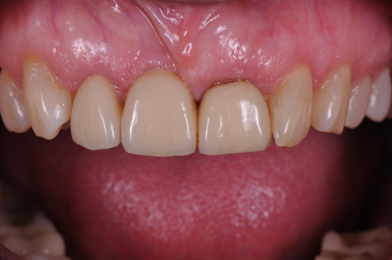 Defective old bridge