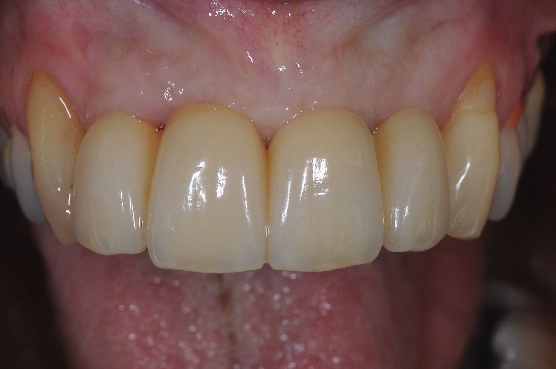 Services Implant Bridges Brisbane Prosthodontics