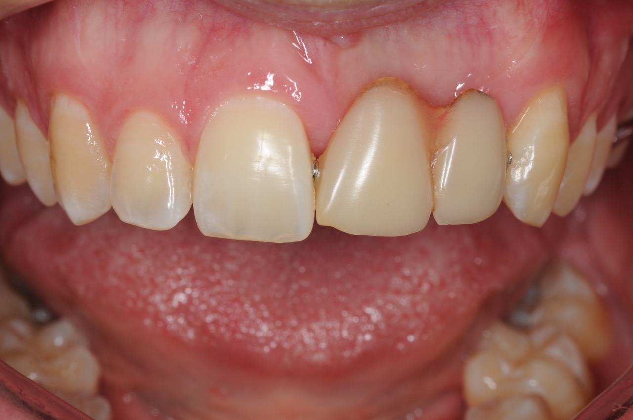 The Partial Denture