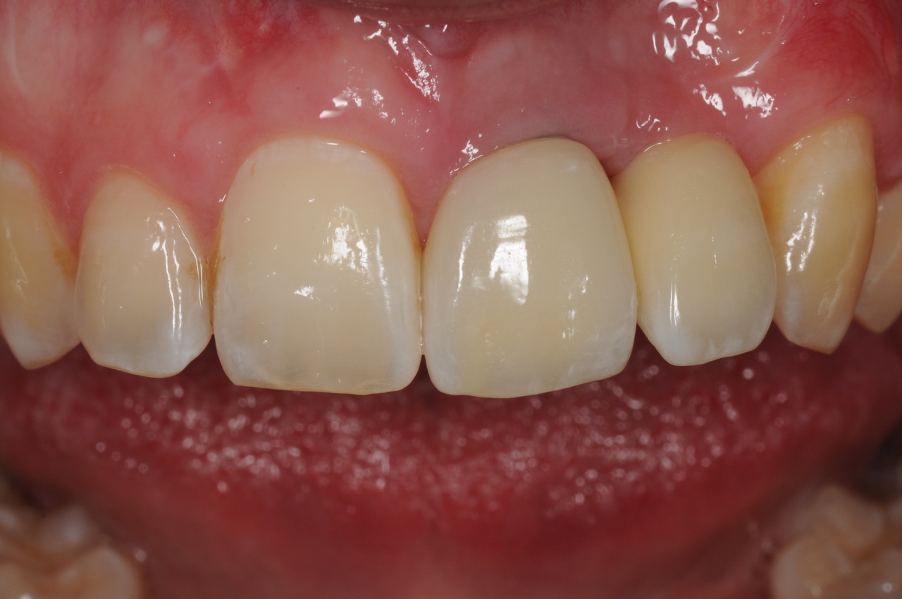 Services Implant Bridges Brisbane Prosthodontics