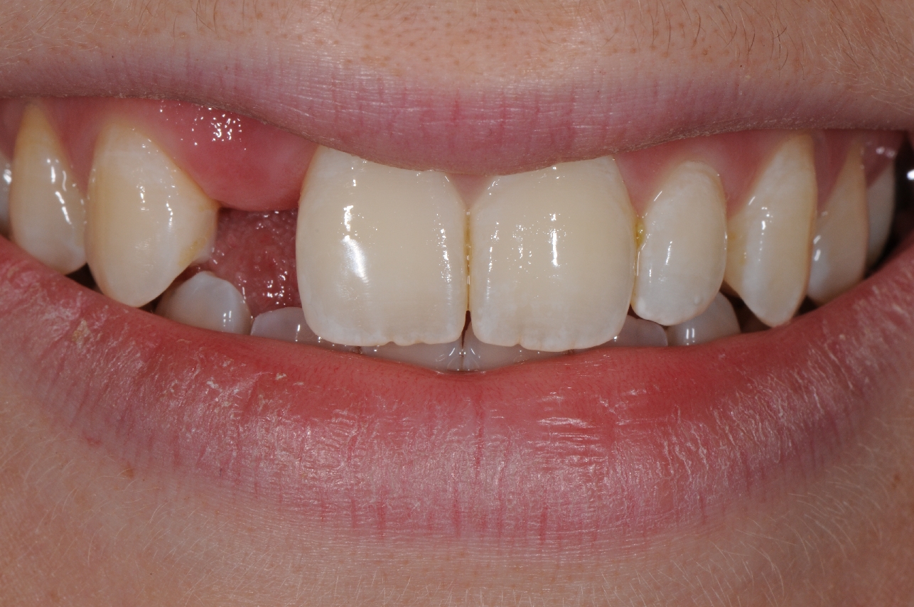 Services Bonded Bridges Brisbane Prosthodontics