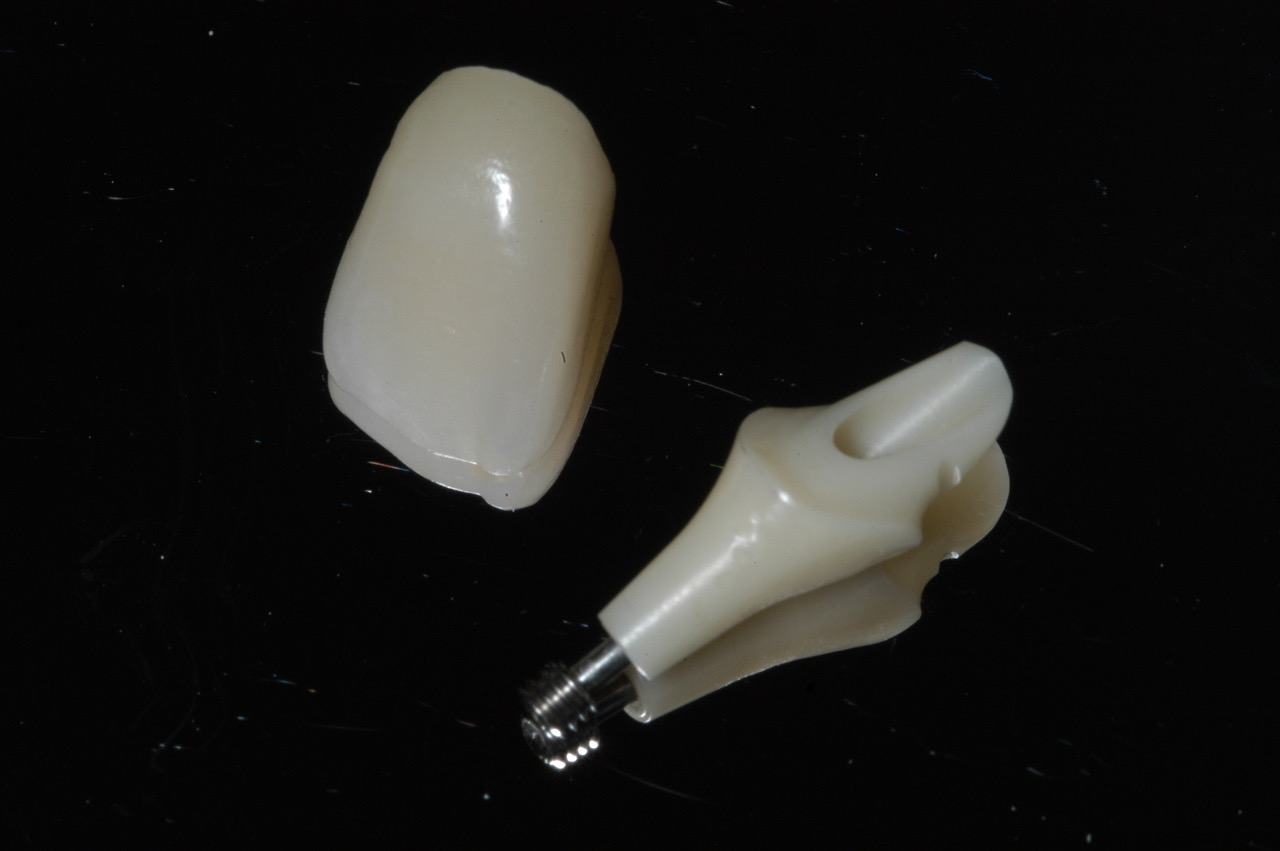 Services Single Tooth Implants Brisbane Prosthodontics