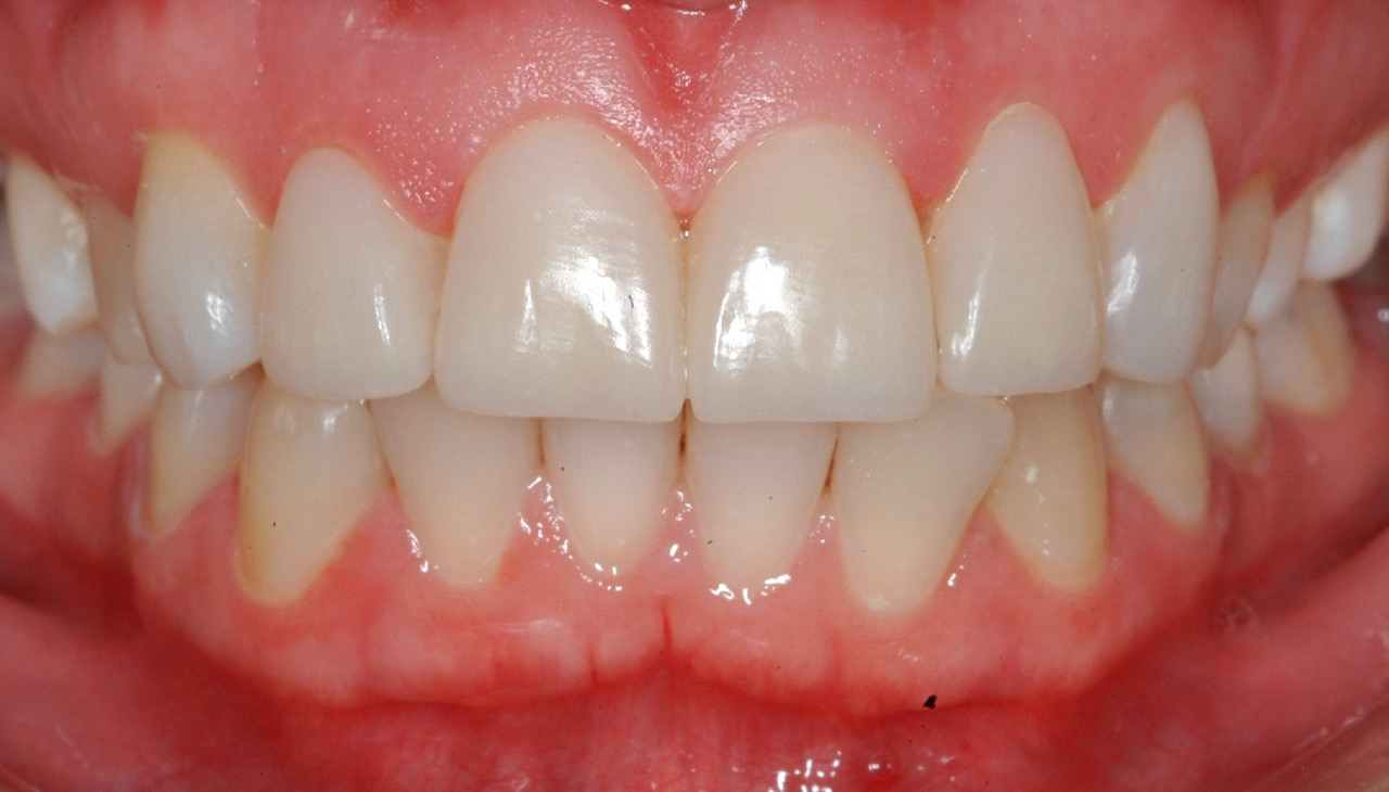 After Composite Buildups